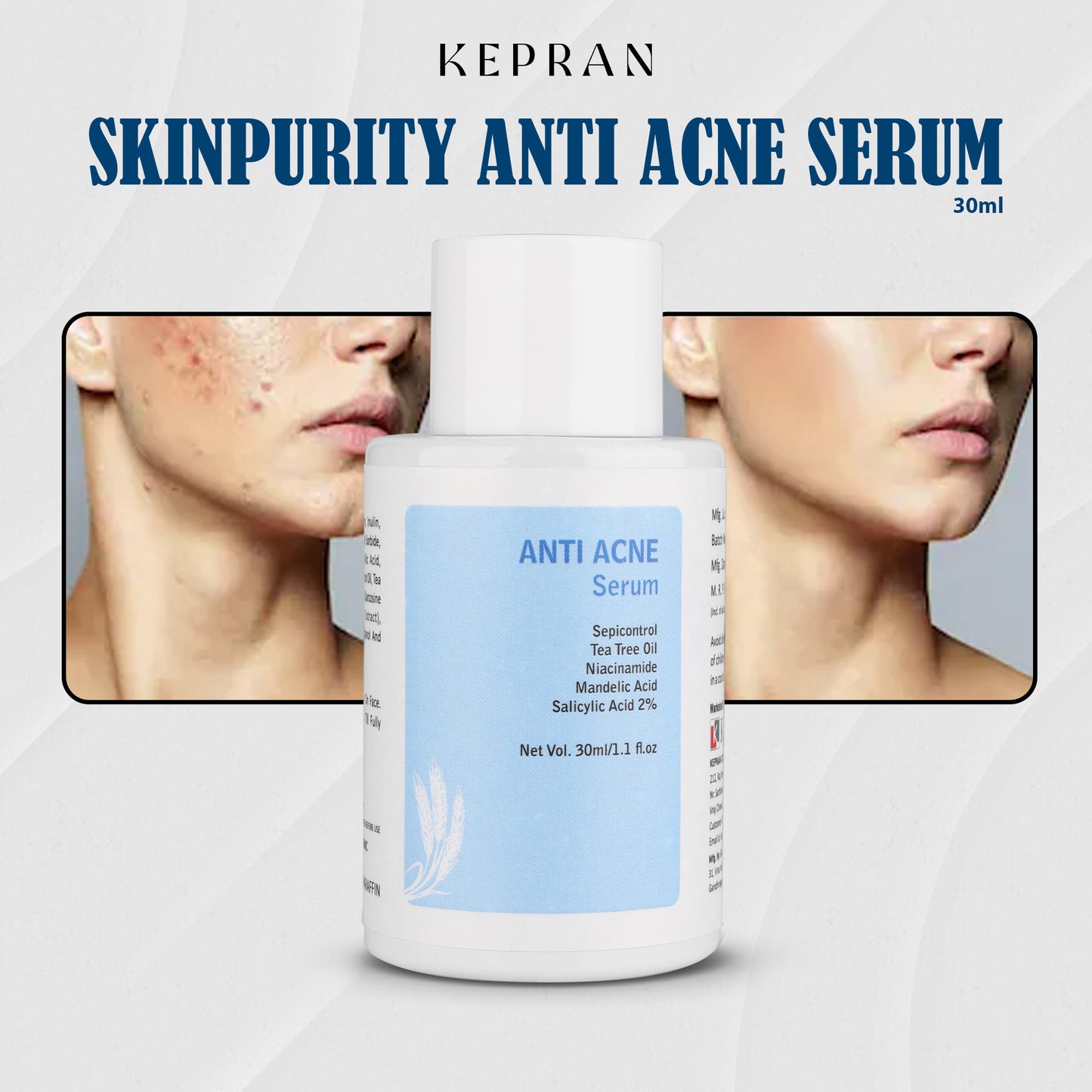 Anti Acne Face Serum